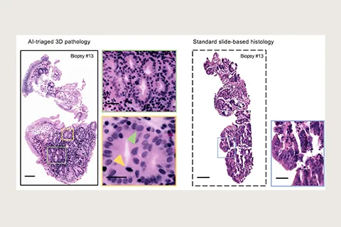 Comparison of AI-triaged 3D pathology and standard slide-based histology of Biopsy #13.