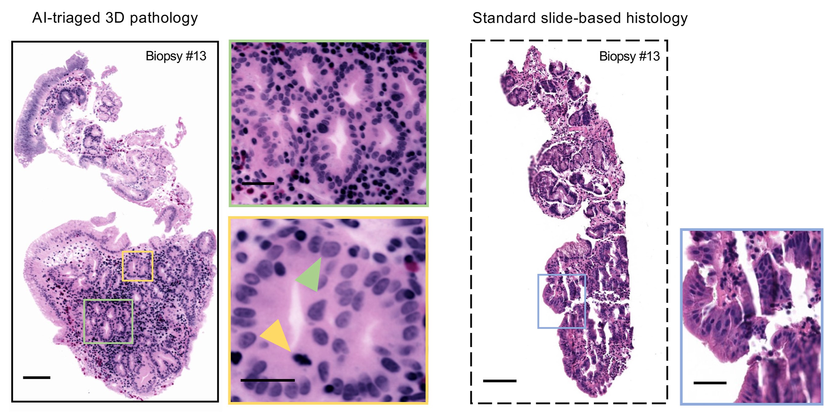 AI-triaged 3D image sections of a biopsy show abnormal precancerous cells on the left, while the 2D images on the right only show benign sections.